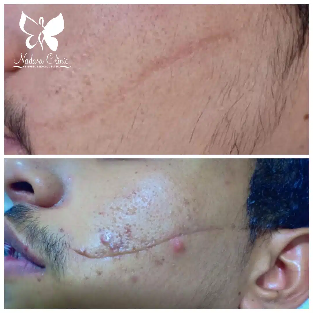 ازالة آثار الندبات بالليزر